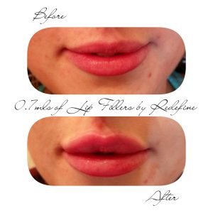 Before & after lip fillers